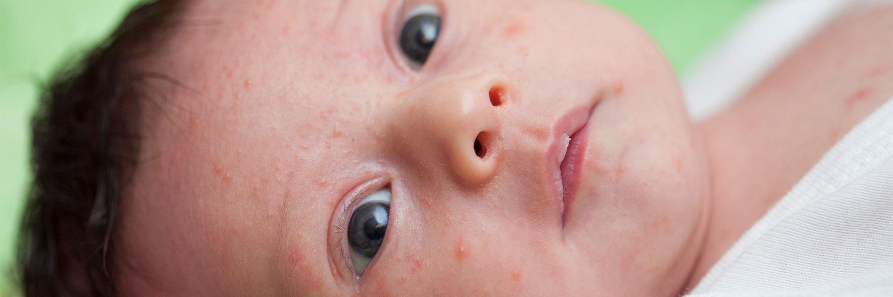 Newborn Spots & Rashes